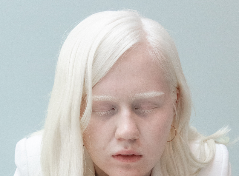 How can Albinism affect vision?